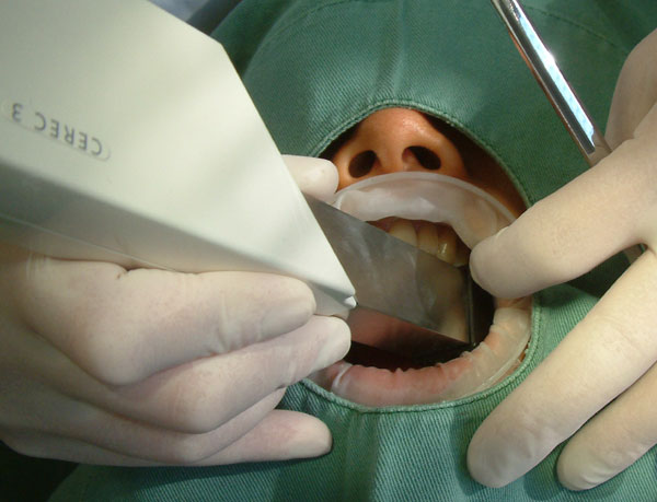 Intraoral scanner